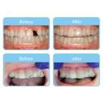 orvance-aligner-pontics-before-after-results